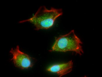 Cellule tumorali - microscopia a fluorescenza